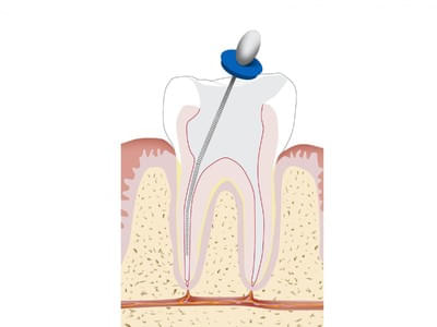 Endodontie-Wurzelbehandlung